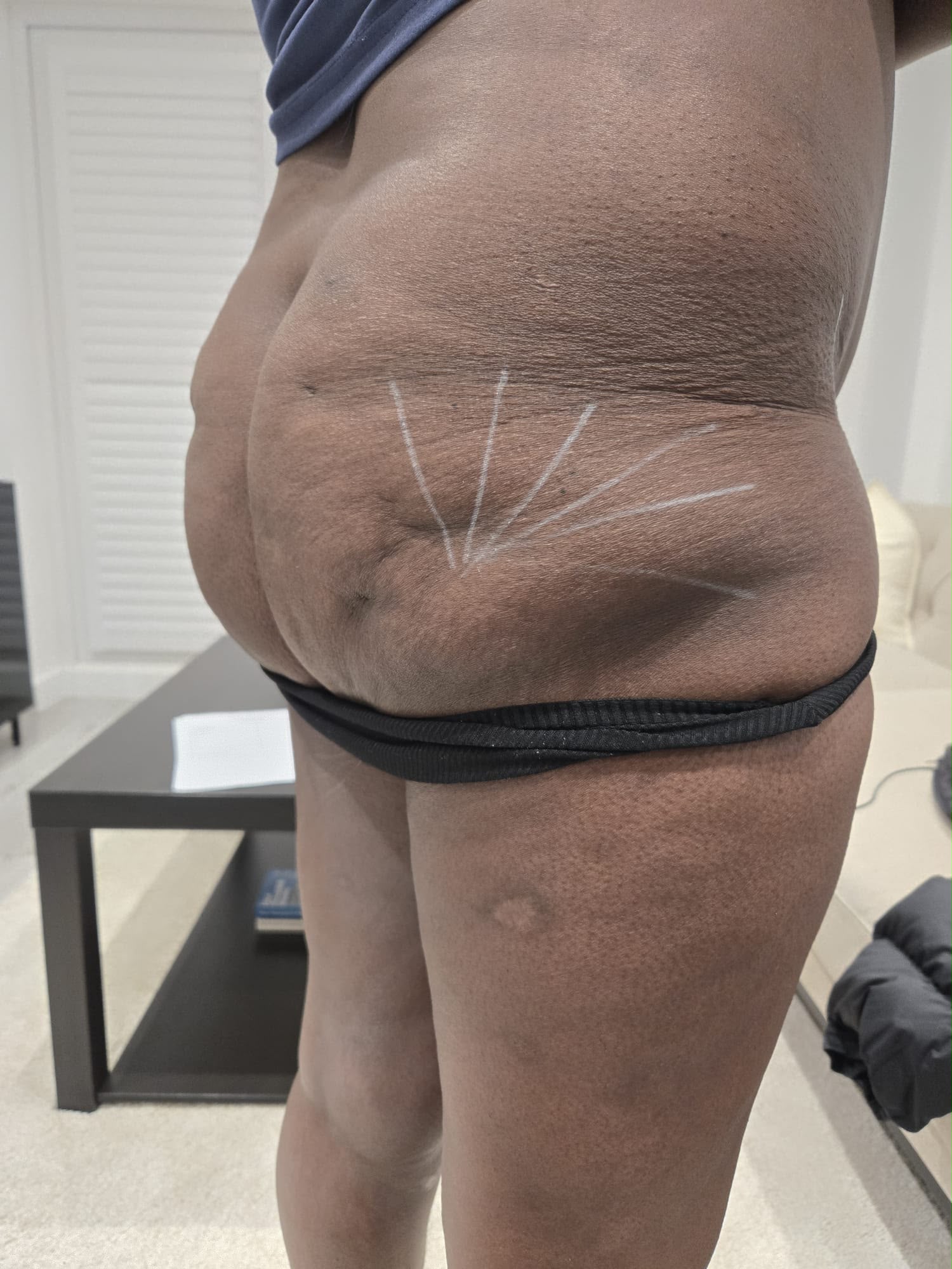 Client before Liquid BBL treatment — standing side view with mapping markings
